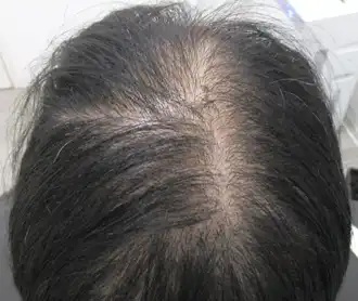 30代症例　後頭部　3カ月後