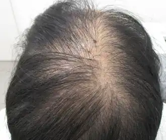 30代症例　後頭部　治療前