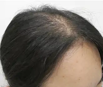 30代症例　右側頭部　3カ月後