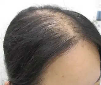 30代症例　右側頭部　治療前