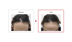 42歳治療開始例